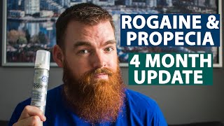 Minoxidil Results  4 Months Using Rogaine amp Propecia [upl. by Travax]