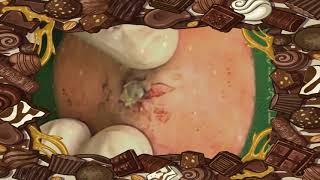 BEST Pimple Popping💖💖 blackheads2023 bestpimplepopping [upl. by Tallula]