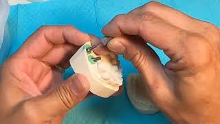 Implant Abutment Placement and Adjustment [upl. by Dymoke]