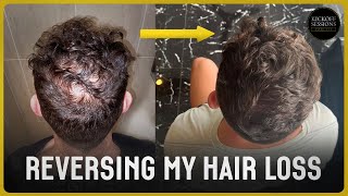 How I Reversed My Hair Loss  1 Year Transformation  NO HAIR TRANSPLANT [upl. by Eiddet46]