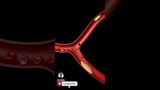 Endovascular Thrombectomy A Key Strategy for Stroke Treatment [upl. by Natanoj987]