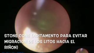 LITIASIS URETERAL URETEROSCOPIA [upl. by Zelig]