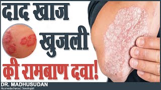 दाद खाज खुजली की रामबाण दवा  Skin Disease  Dr Mdhusudan [upl. by Lluj]