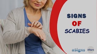 10 Signs of Scabies [upl. by Strickland]