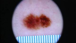 New breakthrough in skin cancer treatment [upl. by Angell94]