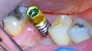 🦷 Full DENTAL IMPLANT PROCEDURE Before and After  Extraction Surgery amp Crown On Back Tooth Molar [upl. by Noramac117]