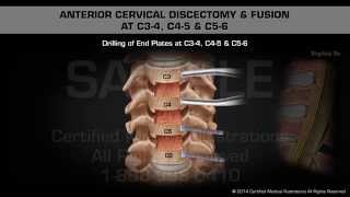 Anterior Cervical Discectomy amp Fusion at C34 C45 amp C56 [upl. by Laband]