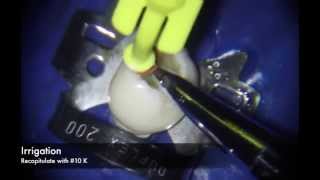 Manual Technique for Curved Root Canal Preparation [upl. by Ahsimet]