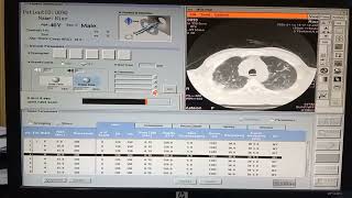 How to do HRCT Chest ct scan  easy way to do hrct chest ct scan  chest infection [upl. by Verney]