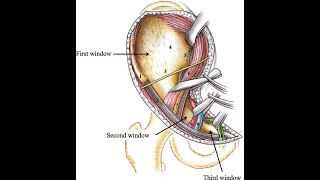 Ilioinguinal Approach to the Pelvis [upl. by Ennaegroeg]