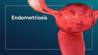 What is Endometriosis [upl. by Barnabas]