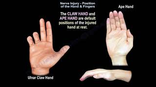 Nerve Injury Position of the Hand amp Fingers  Everything You Need To Know  Dr Nabil Ebraheim [upl. by Past]