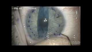 DMEK Corneal transplant using a notouch quottaptechniquequot [upl. by Stephi]