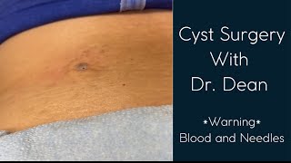 Cyst removal with Dr Dean [upl. by Reivazx208]