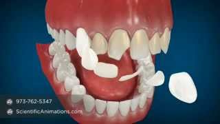 Cosmetic Dentistry Procedures  Dental Animation [upl. by Allison]