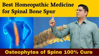 Best Homeopathic Medicine for Spinal Bone Spur Osteophytes of Spine 100 cure  Dr Sunil Patidar [upl. by Albie]