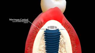 AnyRidge  The Biologically Driven Implant System [upl. by Gasparo]