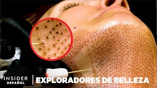 Cómo se realiza un estiramiento facial sin cirugía  Exploradores de belleza [upl. by Marra]