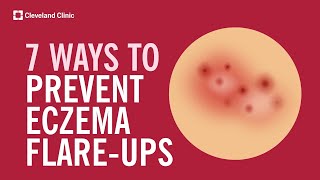 7 Ways to Prevent Eczema FlareUps [upl. by Bentley101]