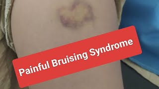 Painful Bruising Syndrome [upl. by Otxis]