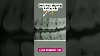 Horizontal Bitewing Radiograph  Dental radiograph [upl. by Donaugh]