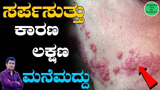 ಸರ್ಪಸುತ್ತು ಸಮಸ್ಯೆಗೆಮನೆ ಮದ್ದು  Sarpa Suttu in Kannada  Sarpa Suttu Symptoms in Kannada [upl. by Okubo537]