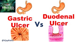 Peptic Ulcer Disease GASTRIC VS DUODENAL ULCERS [upl. by Cerell]