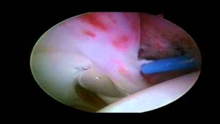 Labral Tear  Detached Anterior Labrum [upl. by Llednol566]