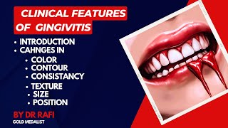 Clinical Features Of Gingivitis  Periodontology Lecture [upl. by Llet]