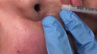 Injecting hypertrophic scars [upl. by Stover]