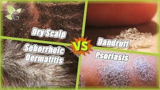 Dry Scalp vs Dandruff vs Seborrheic Dermatitis vs Psoriasis [upl. by Lehcem]