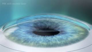 Photorefractive Keratectomy PRK Laser Eye Surgery [upl. by Yelserp]