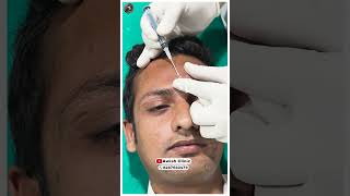 Unbelievable Skin Transformation After Subcision Treatment Awish clinic [upl. by Frantz]