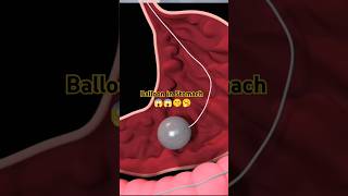 Balloon weight Ioss surgery About Balloon 🤫🫣SurgeryviralShortsshortsfeeds [upl. by Bihas]