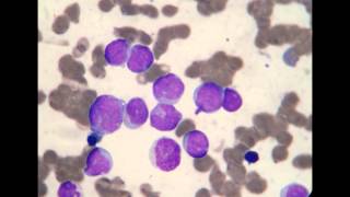 Acute Myeloblastic Leukemia M1 [upl. by Ecinereb]