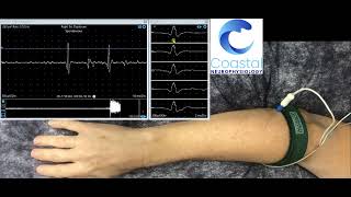 Needle EMG demonstration [upl. by Lainey]