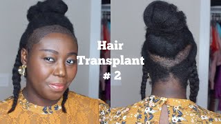 My 2nd Hair Transplant [upl. by Charo]