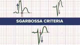 Sgarbossa Criteria  MEDZCOOL [upl. by Pietro]