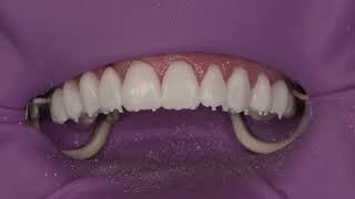 Clinical Tip on veneer temporization [upl. by Nosnibor259]