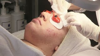 Acne Facial Treatment And Analysis [upl. by Adiraf]