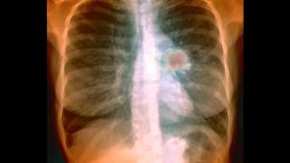 Reverse the Damage  Lung Cancer [upl. by Ilyk724]