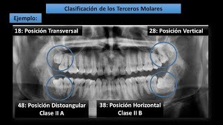 Clasificación de Winter  Pell y Gregory para Terceros Molares Cordales [upl. by Maurise]