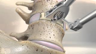 STALIF M™ MIDLINE II Surgical Technique Animation  Anterior Lumbar Interbody Fusion [upl. by Xer923]