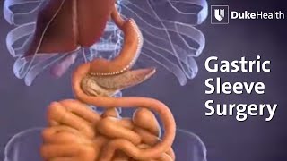 Gastric Sleeve Surgery  Duke Health [upl. by Namqul469]