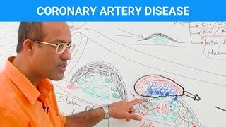 Coronary Artery Disease  Ischemic Heart Disease  Angina🫀 [upl. by Zechariah]