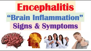 Encephalitis “Brain Inflammation” Signs and Symptoms amp Why They Occur [upl. by Lorollas73]