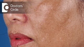 Treatment of Melasma  Dark Spots on Face  Dark patch on face  Dr Satish D A  Doctors Circle [upl. by Haymo427]