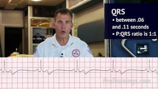 Bradycardia ECG Rhythm Interpretation [upl. by Shaw313]