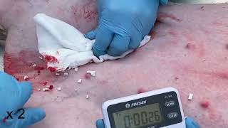 Bioinspired Hemostatic Strategy via Pulse Ejections for Severe Bleeding Wounds Movie 9 [upl. by Ardena]