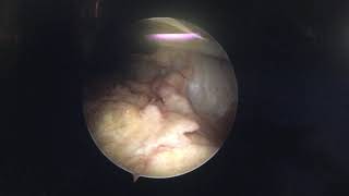 osteochondral defect of knee joint part 1 [upl. by Ilagam852]